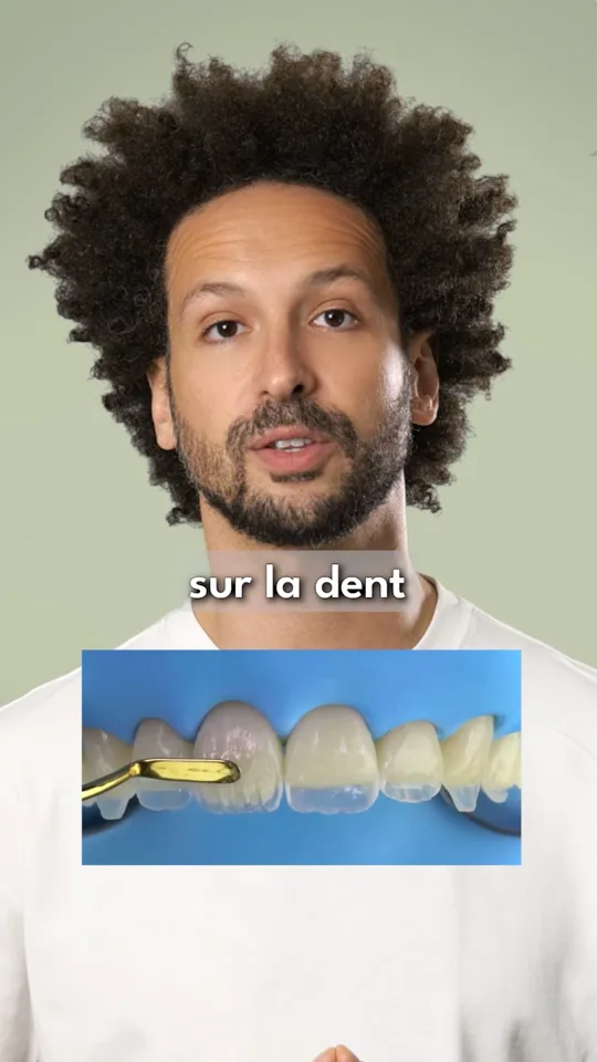 FAQ - Composites esthétiques stratifiés