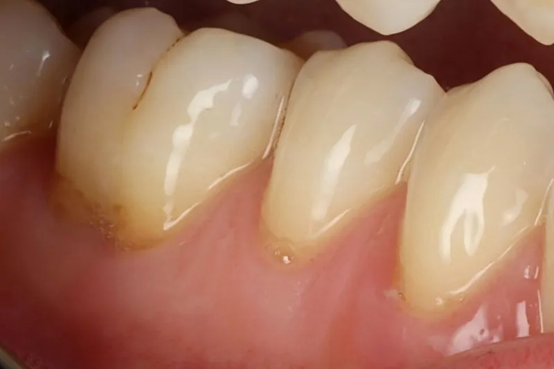 Collets exposés par une récession gingivale, cause fréquente de dents sensibles à évaluer avant un blanchiment des dents sensibles