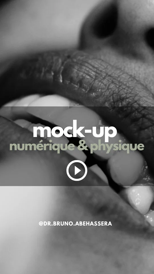 Mock-up physique : essayer son futur sourire
